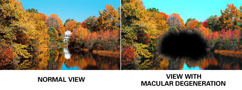 Image of what a person with 20/20 sees and image of what a person with macular degeneration sees